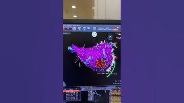 3D Ripple map of atrial flutter cardiac arrhythmia