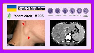 [ Krok 2 Medicine ] Year: 2020 - 005 (Ministry of Public Health of Ukraine) screenshot 5