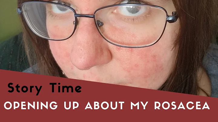 STRANGERS Make FUN of my Rosacea!? (Story Time)