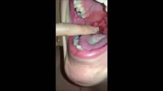 Tonsil Stone Or Tonsoliths Removal