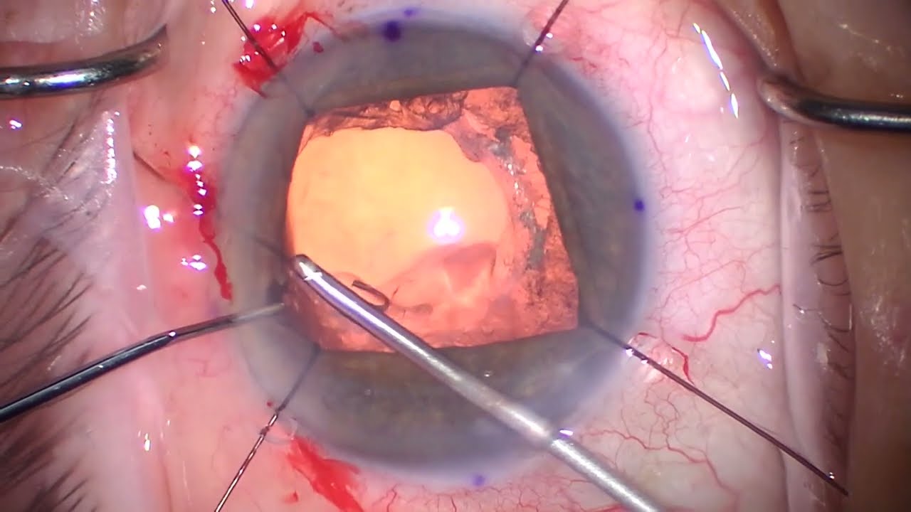Complicated Cataract surgery. 1 piece IOL in sulcus UGH replaced for optic captured 3 piece