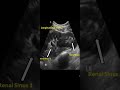 Crossed Fused Ectopia of Kidney Ultrasonography.Awerenes of All.Short medical lecture video viral@##