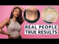 Laser Hair Removal | Real People, True Results