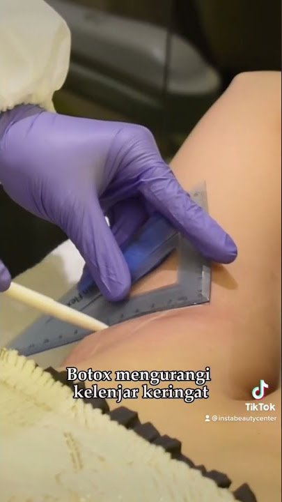 Kelenjar keringat berlebih?? Botox-in aja tsay!😍