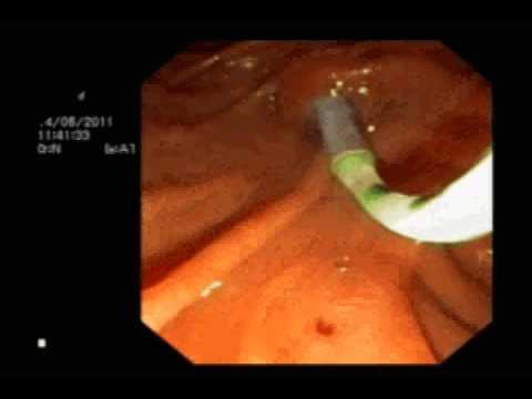 დუოდენოსკოპია, ნაღვლის საერთო სადინარის სტენტის სანაცია