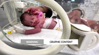 GRAPHIC WARNING: Gazan baby saved from her dead mother's womb dies | REUTERS