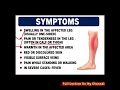 DVT Symptoms Explained in English &amp; Urdu | Adult Health Nursing