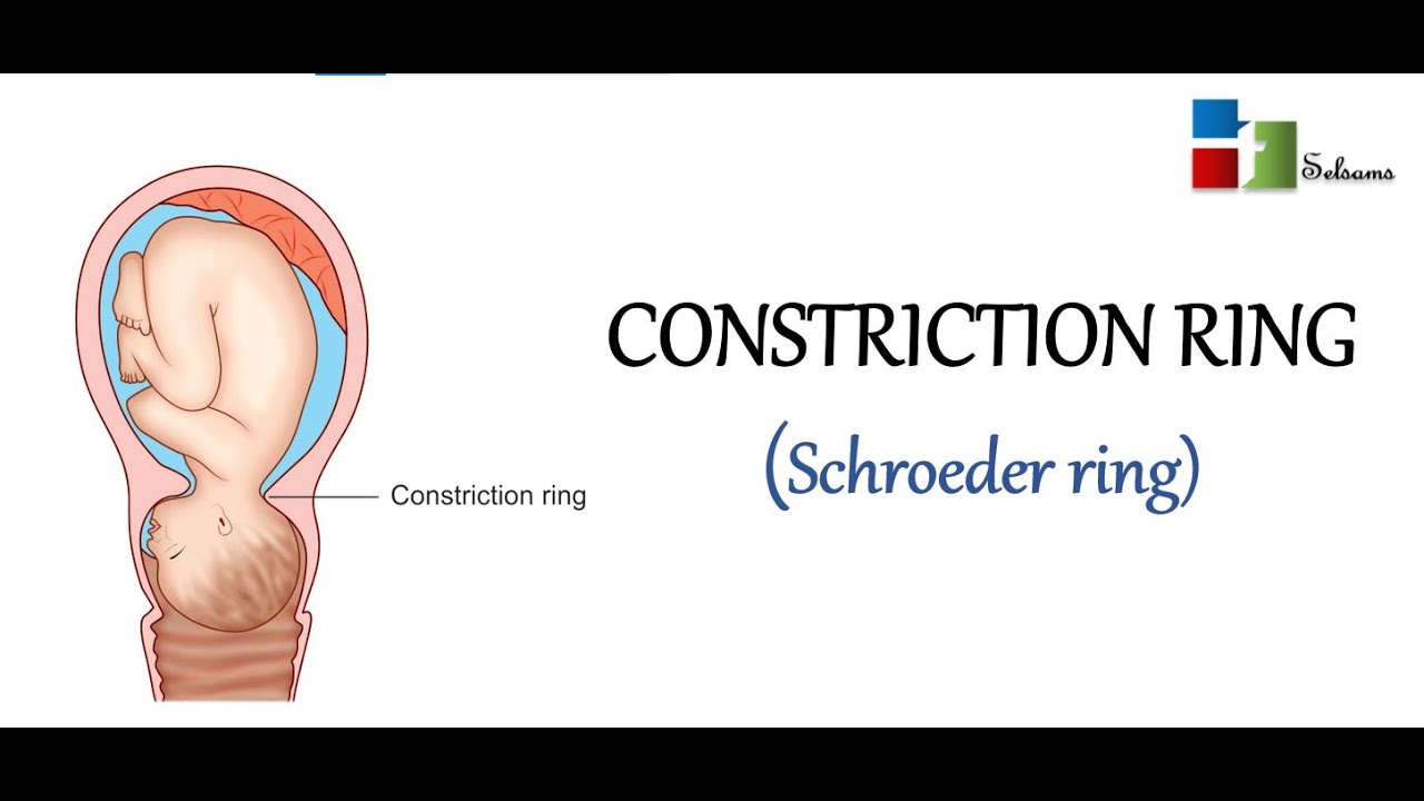 OLCreate: HEAT_LDC_ET_1.0 Labour and Delivery Care Module: 9. Obstructed  Labour: 9.3.2 Bandl's ring | OLCreate