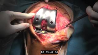 Intervención Quirúrgica | Cirugía ortopédica