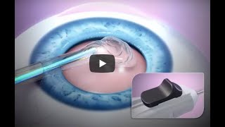 ZEPTO®️ Procedure Animation