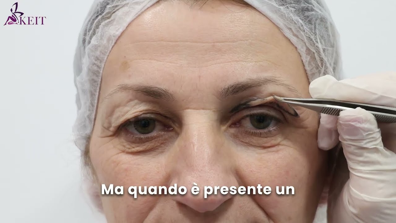 Blefaroplastica Superiore: Cos’è, Quando Serve e Risultati Reali