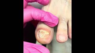 Обработка грибка , от ногтя ничего не осталось #подология #nails #вросшийноготь #грибокногтей