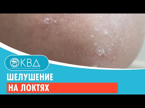 😐 Шелушение на локтях. Клинический случай №266