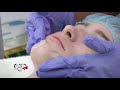 Los beneficios del “Peeling Ultrasónico Facial”