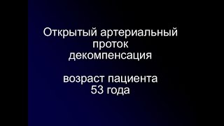 Открытый Артериальный Проток В Ст. Декомпенсации, Возраст Пациента 53 Года