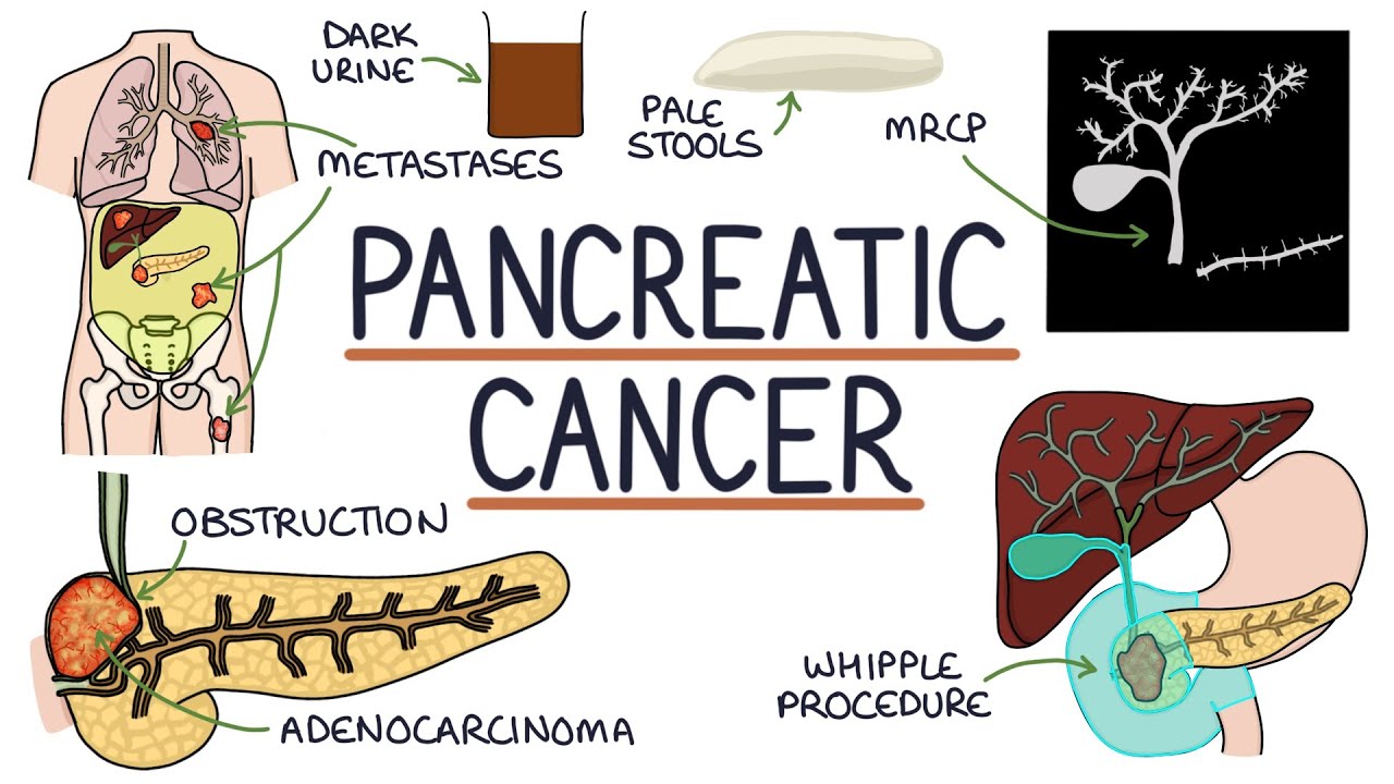 pancreas cancer