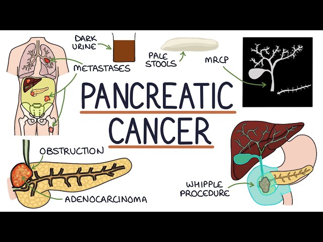 Understanding Pancreatic Cancer class=