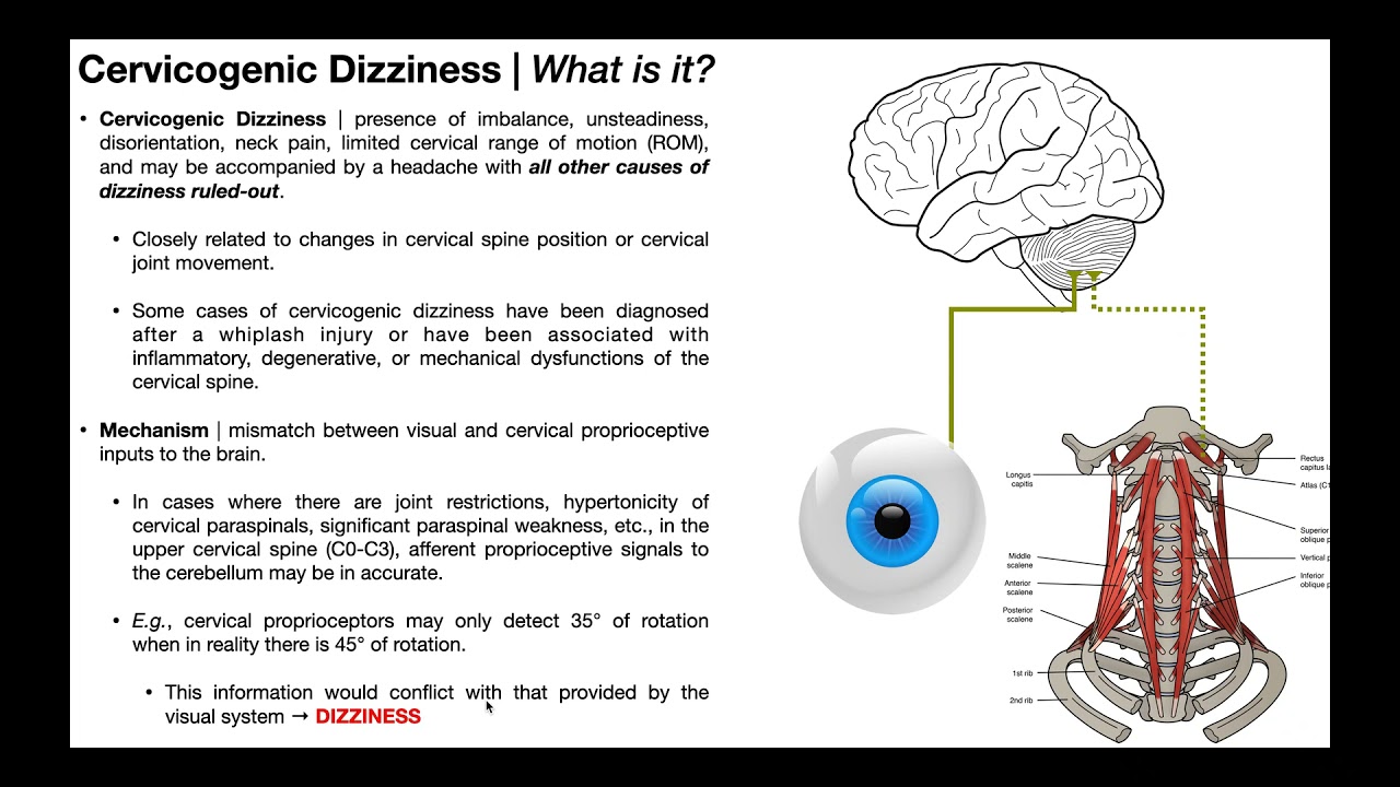 Cervicogenic Dizziness What Is It Mechanism Diagnosis Youtube