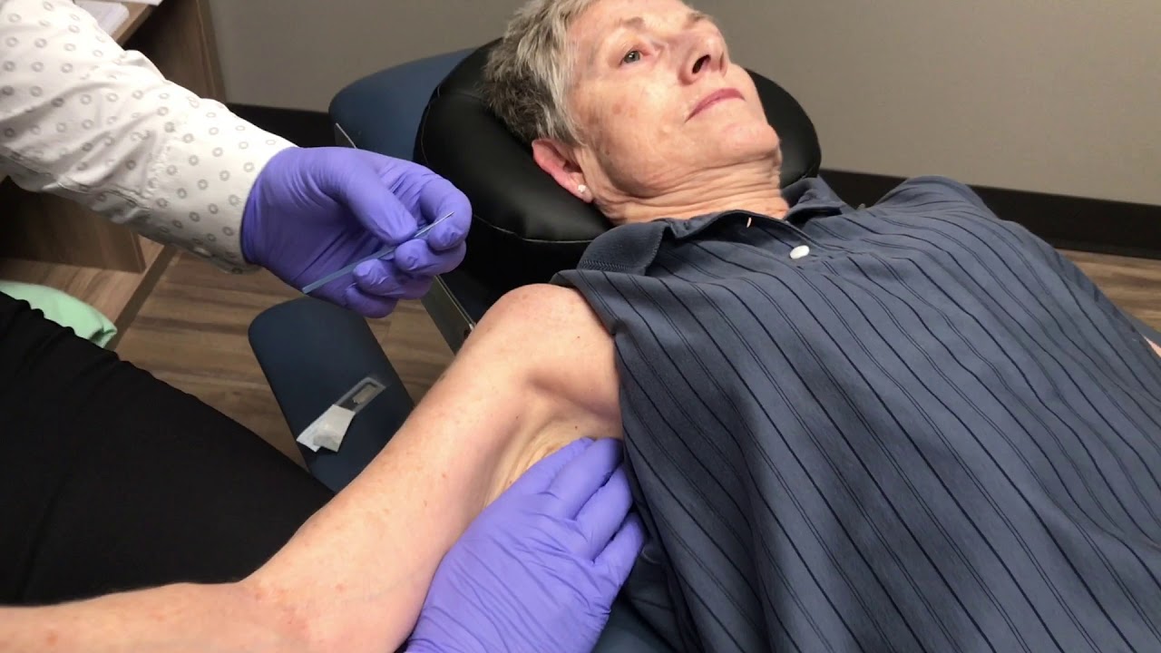 Treating Frozen Shoulder With Dry Needling YouTube