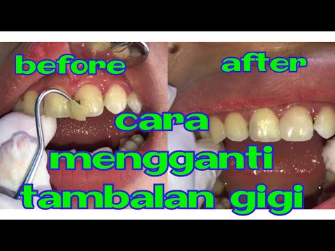 Video: Cara Membuang Tampalan