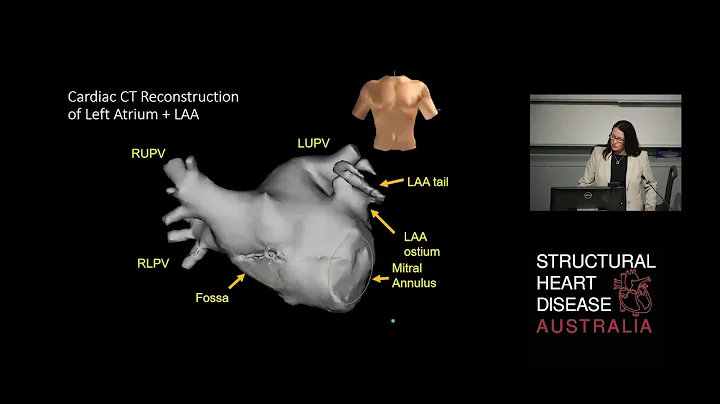 Left Atrial Appendage Non Closure - Dr Julie Humph...