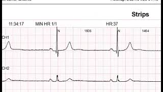 How to use heartrec lite ? pt3 screenshot 4
