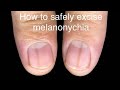 How to excise melanonychia. Easy steps 