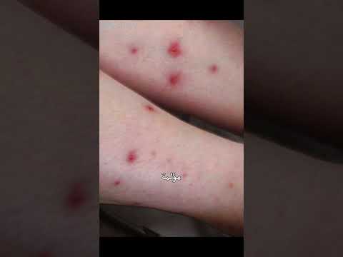 بق الفراش حقائق مثيرة عن هذا الحشرة