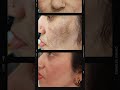 Melasma is treatable with the #skincare #howtogetridofdarkspots #dermatologistapproved