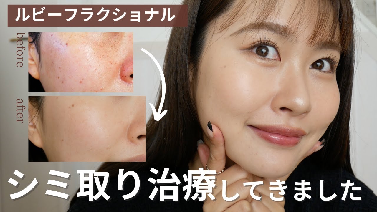【美容医療レポ】シミ取りレーザーをしてきました！！〈 ルービーフラクショナル 〉