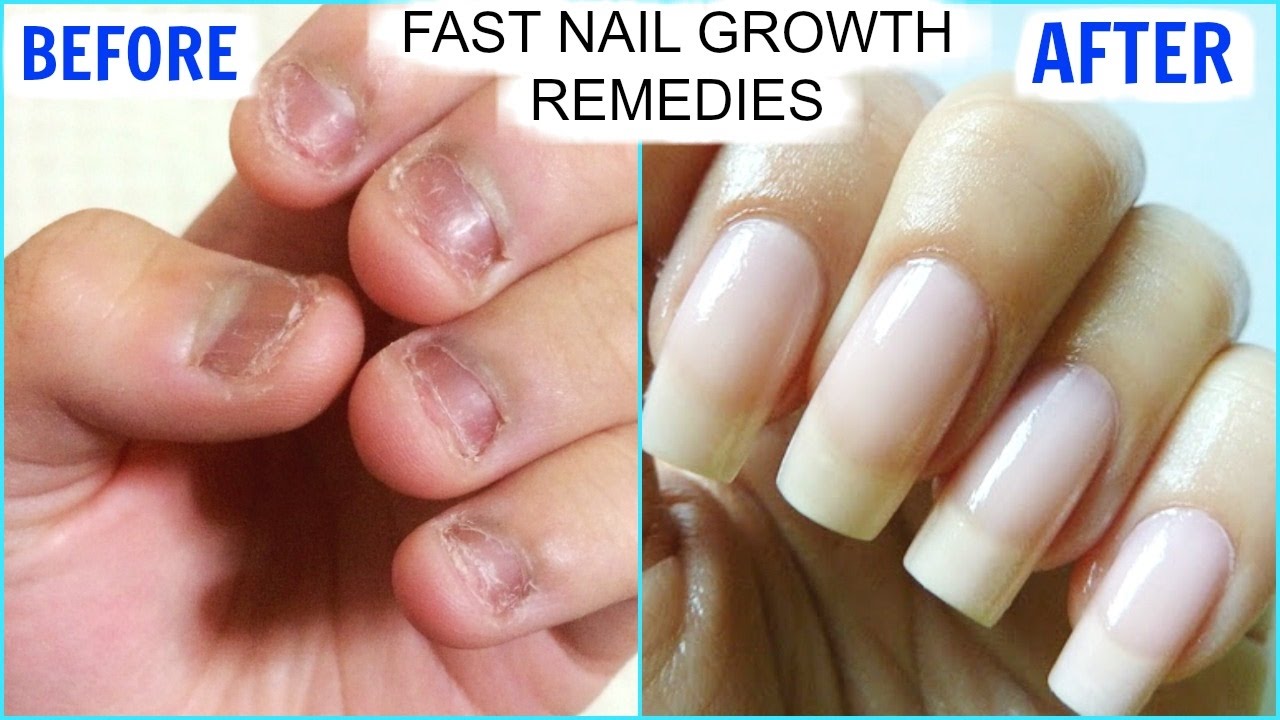 नाखून लम्बे मजबूत और सुंदर बनाने के उपाय/Nakhun badhane ka tarika /nails  growth tips by Dr Rupal | नाखून लम्बे मजबूत और सुंदर बनाने के उपाय/Nakhun  badhane ka tarika /nails growth tips