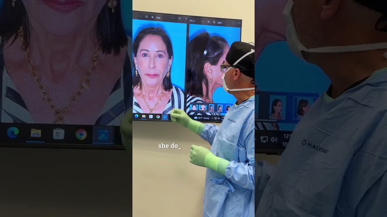 Non-Surgical Facial Rejuvenation with Fat Grafting, Lip Lift & CO2 Laser