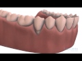 Soft tissues grafting - Lapointe dental centres