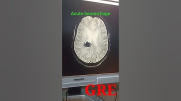 MRI brain Gre sequence axial acute hemorrhage
