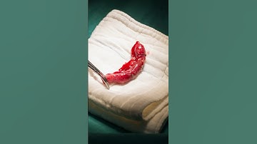 Appendicitis! Do You Really Need Surgery to Fix It?