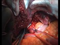 Central hepatectomy for centrally located cholangiocarcinoma by dr hitesh chavda