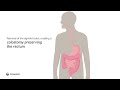 Creation of end colostomy by removing sigmoid colon  ostomy surgery  coloplast india