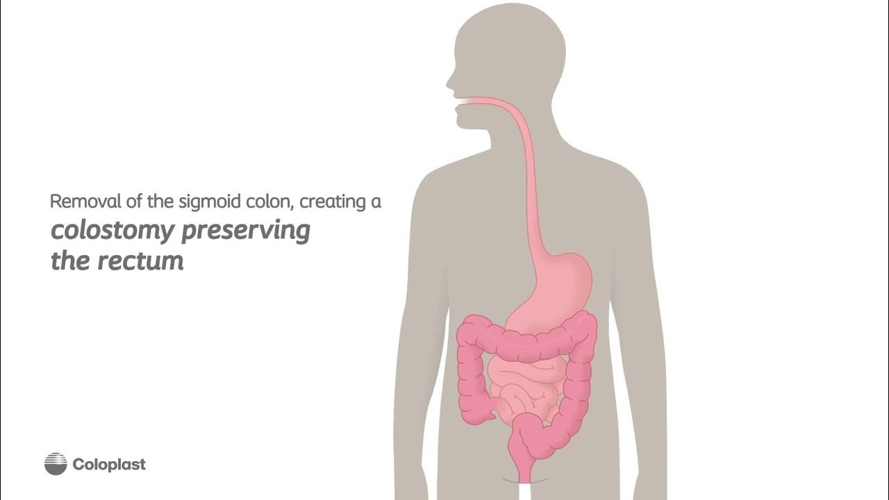 Creation of end colostomy by removing sigmoid colon Ostomy surgery