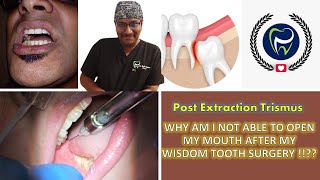 Dr Rudra Mohan | WHY CAN'T I OPEN MY MOUTH AFTER WISDOM TOOTH SURGERY !!?? Post Extraction Trismus