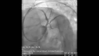 Ana Koroner Stentleme IVUS (Intra Vasküler Ultrason) Kulanımı!