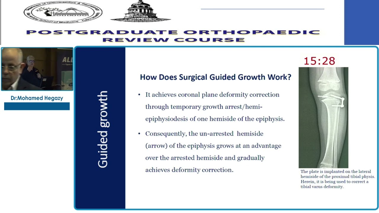 9 Growth Modulation by PETS or 8 plates   Mohamed Hegazy
