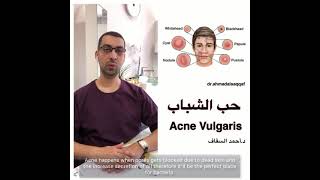 دكتور أحمد السقاف Dr.Ahmad Alsaqqaf/  حب الشباب Acne Vulgaris