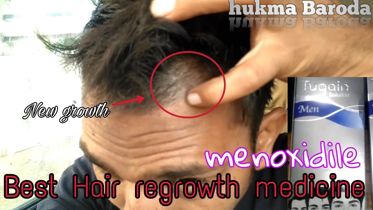Best hair regrowth medicine in world ( बालों को फिर से उगाने की साबसे कारगर देवा ) YouTube