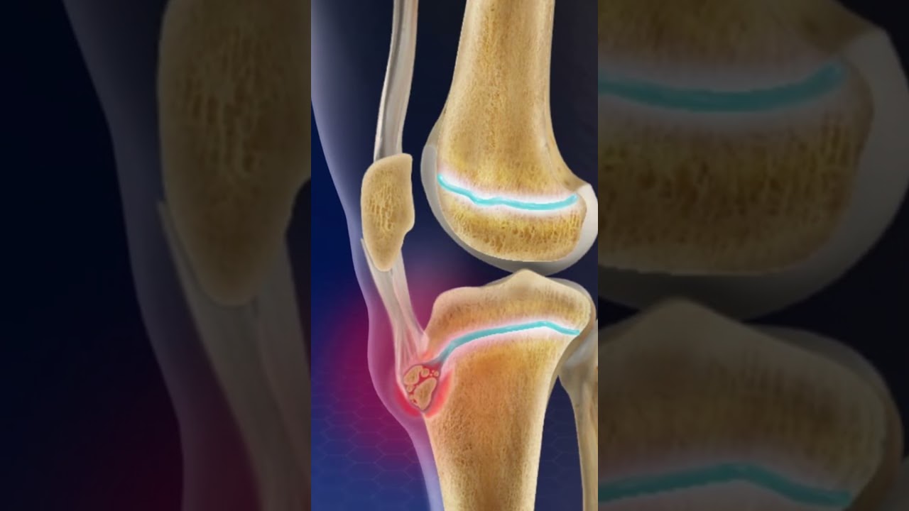 🔍 Descubre por qué los adolescentes pueden experimentar dolores de rodilla 😫