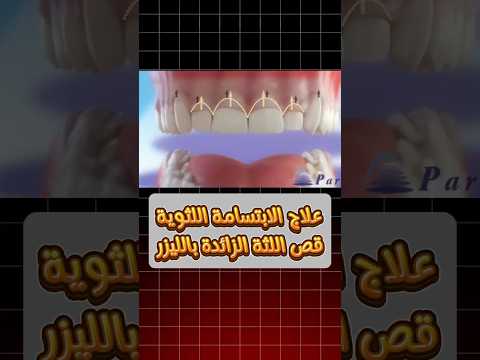 علاج الابتسامة اللثوية قص اللثة الزائدة بالليزر