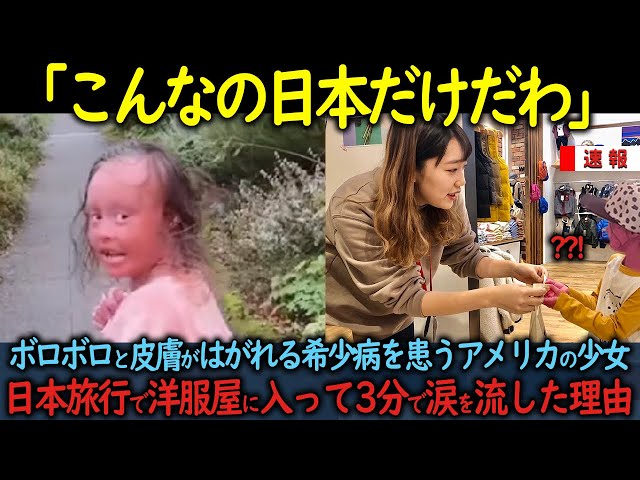 【海外の反応】「こんなの日本だけだわ」ボロボロと皮膚がはがれピエロと呼ばれるアメリカの少女が日本旅行で洋服屋に入って3分で涙を流した理由 class=