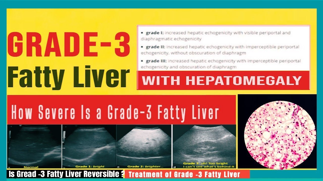 Grade 3 Fatty Liver kya hai How severe is fatty liver grade 3 Grade