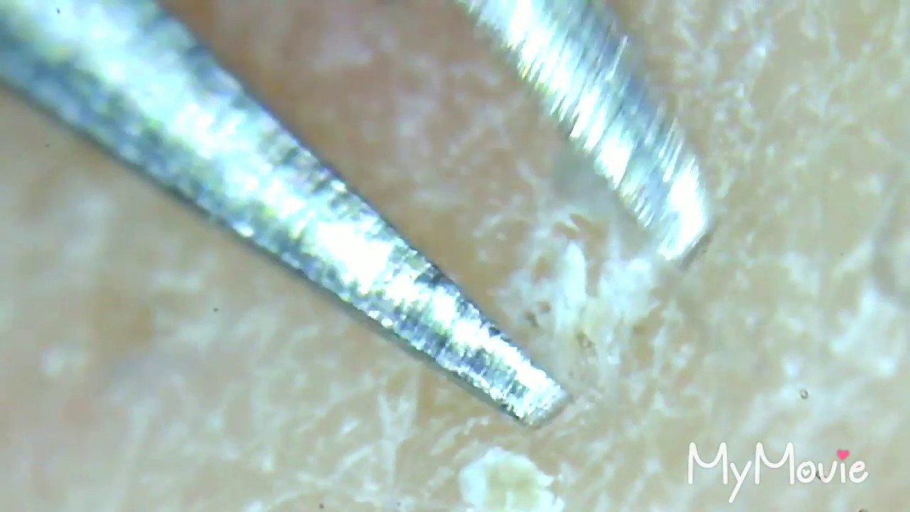 Satisfying Compilation Ingrown Hair Tweezing Plucking