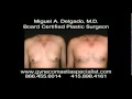 Gynecomastia surgery450 before and after photos by miguel delgado md
