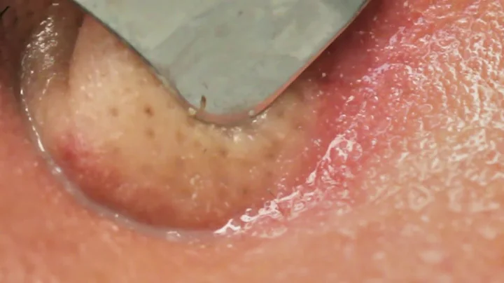 Ultrasonic Exfoliating Skin Scrubber